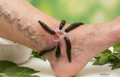 Leech Therapy for Chronic Varicose Ulcers